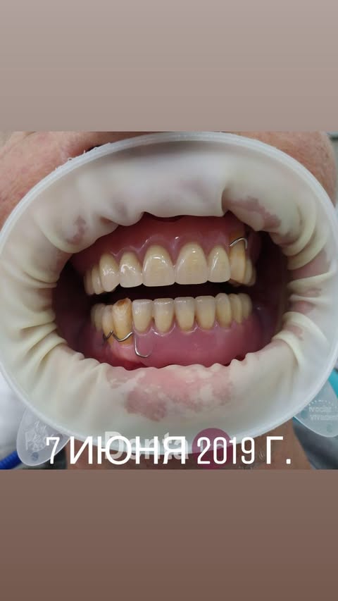 После лечения